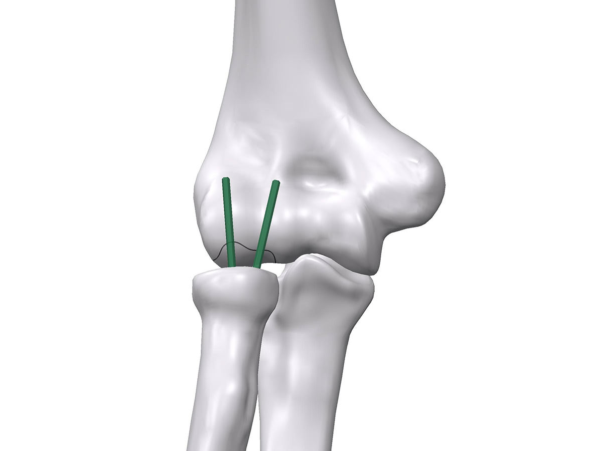 Animated picture of distal humeral fracture operated with two biodegradable pins