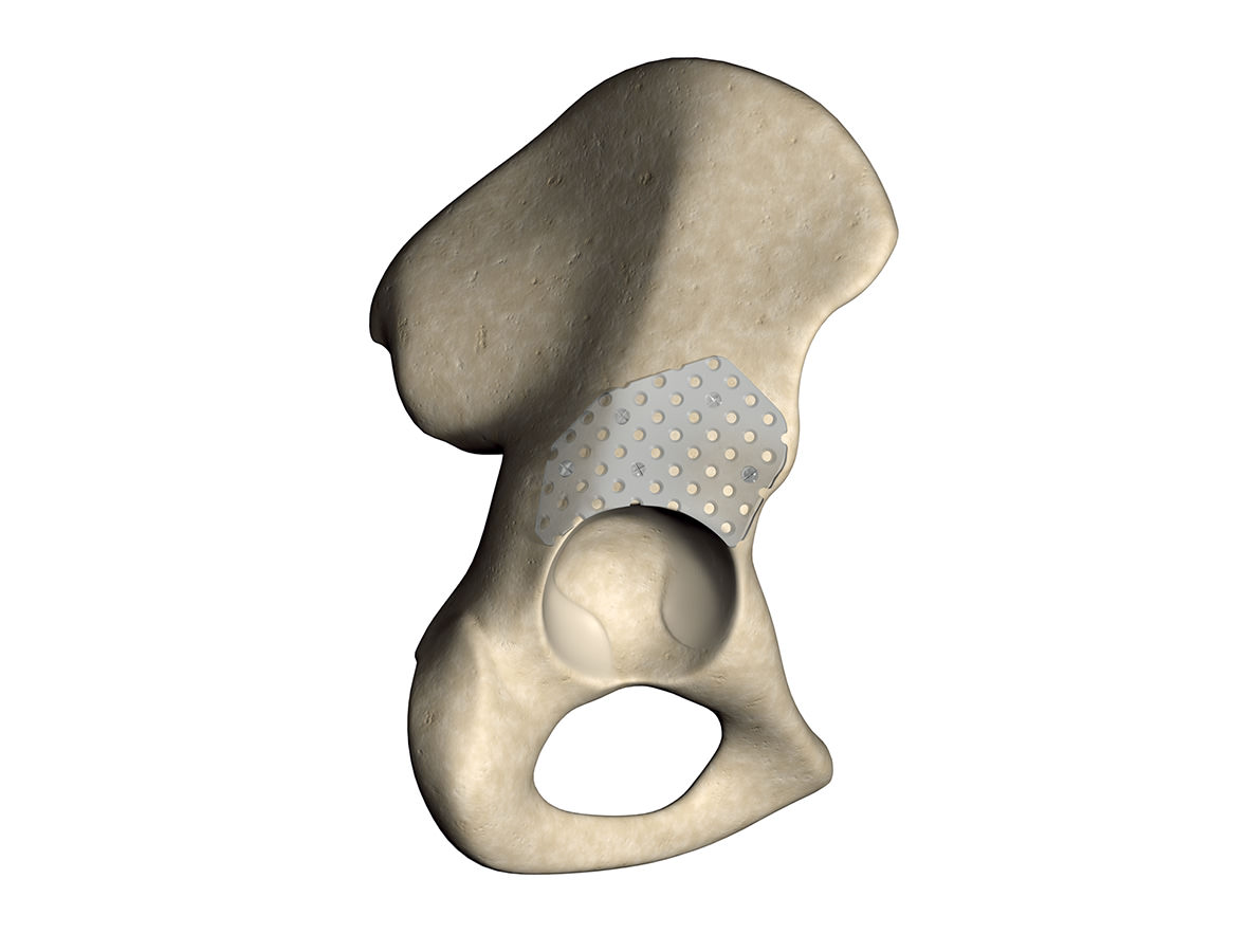 Biodegradable plate attached on hip with resorbable screws