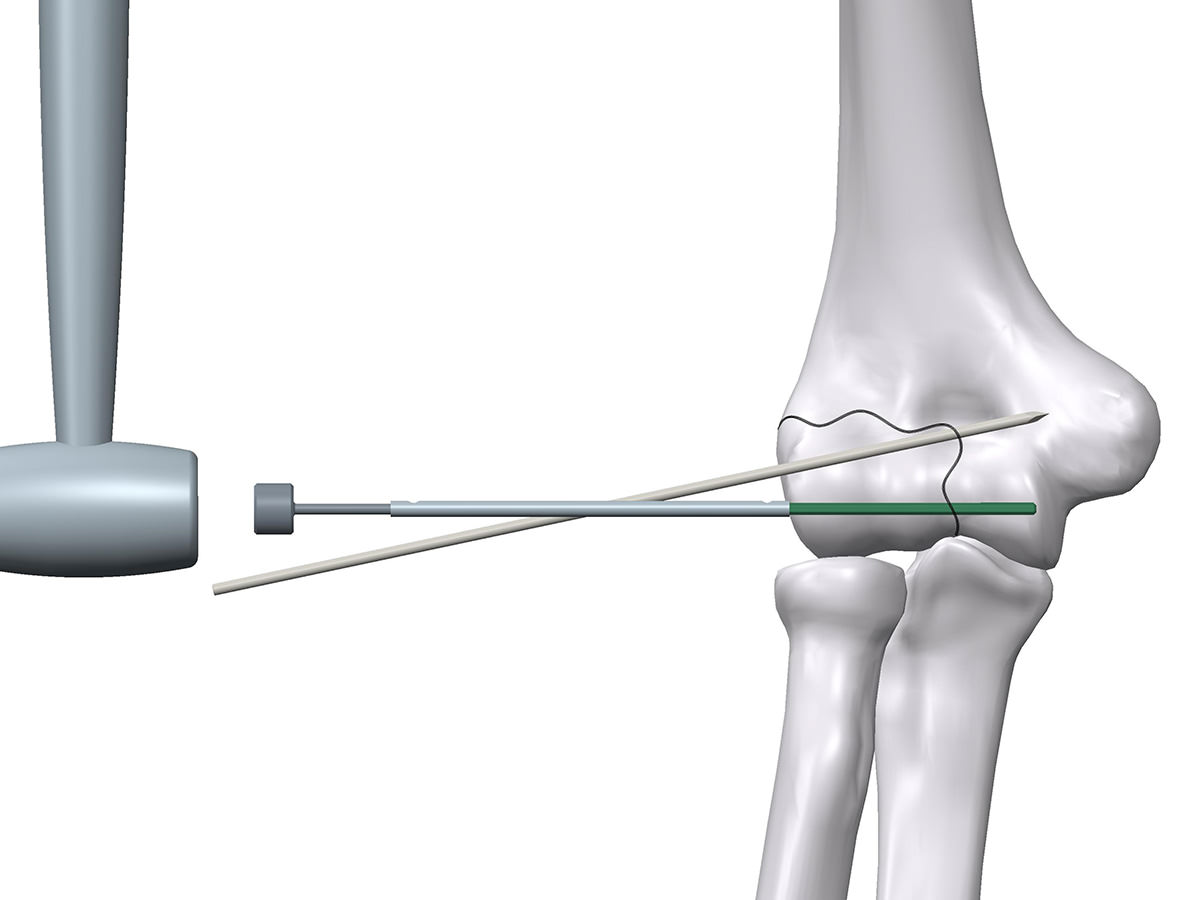Animated picture of replacing the first K-wire with biodegradable pin in humerus fragture surgery