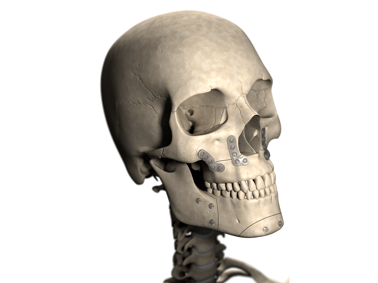 A human skull with fractures with bioabsorbable surgical plates and screws on the fractures.