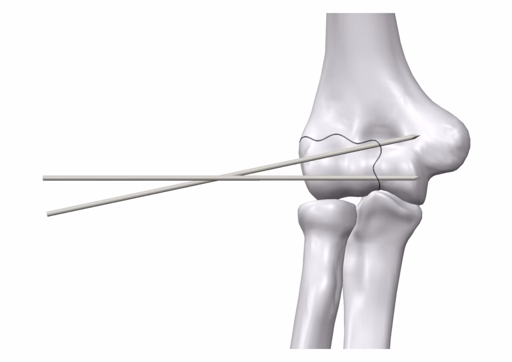 Surgical technique step 1 for arthroscopic operation using bioabsorbable Inion FreedomPin™.