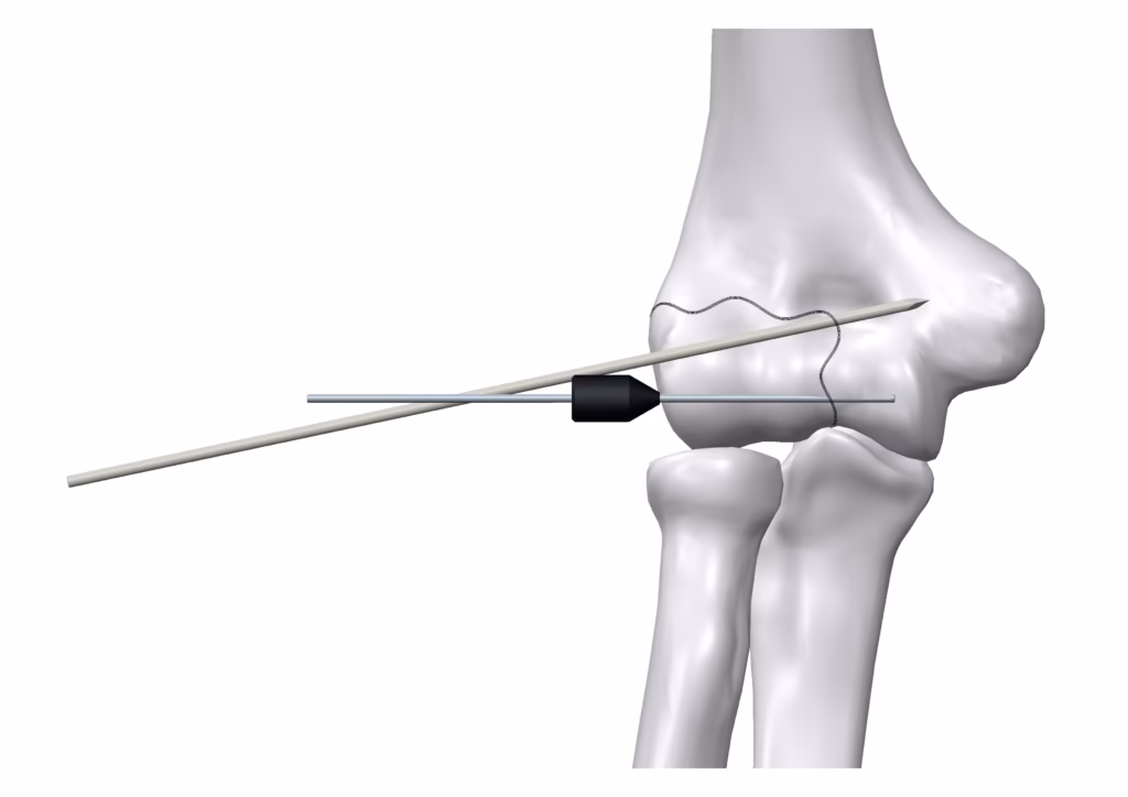 Surgical technique step 2 for arthroscopic operation using bioabsorbable Inion FreedomPin™.