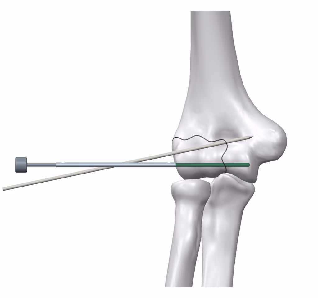 Surgical technique step 4 for arthroscopic operation using bioabsorbable Inion FreedomPin™.