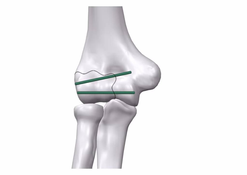 Surgical technique for arthroscopic operation using bioabsorbable Inion FreedomPin™ final step with two pins installed.
