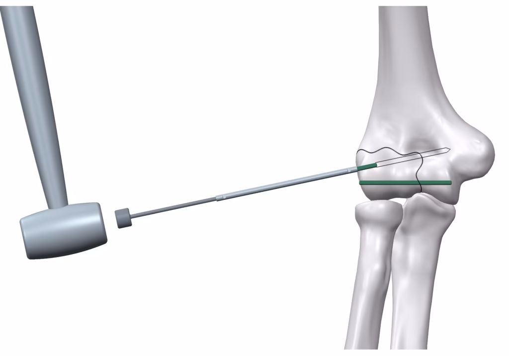 Surgical Technique step 5 – Arthroscopic Operation using bioabsorbable Inion FreedomPin™